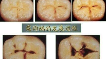 别等孩子的恒牙都烂完了,才知道这个办法!