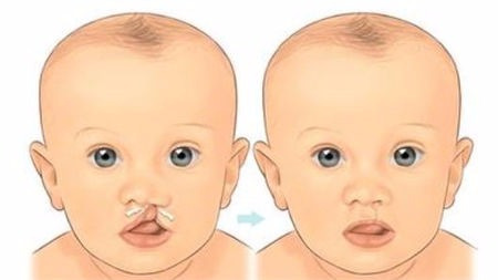 唇腭裂基因检测真的可以预防“兔唇”宝宝吗?