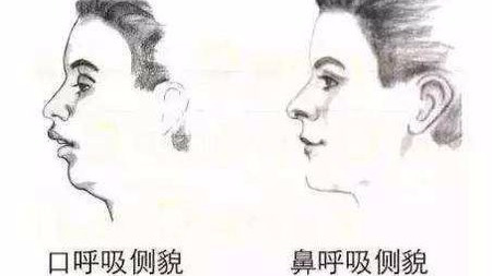 长期用嘴呼吸相貌会变丑?