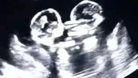 双胞胎在妈妈肚子里打架的视频火了!这些事你更需要知道
