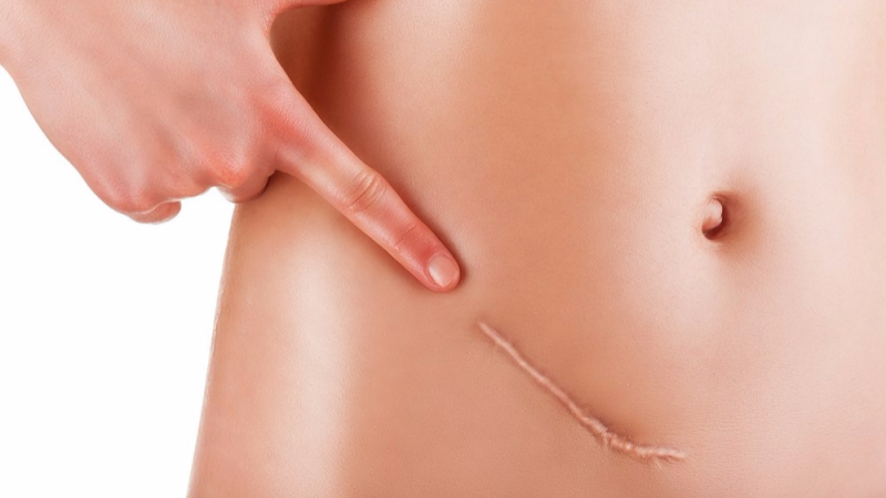 疤痕应该如何去除?这些真相你需要知道!