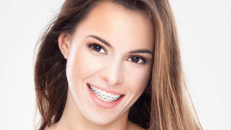 错过了“黄金期”,成年人是否还适合做牙齿矫正?