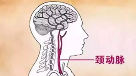 50%中风都跟颈动脉狭窄有关,如何预防?