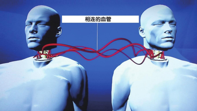 换头狂人 ——塞尔吉奥·卡纳维罗