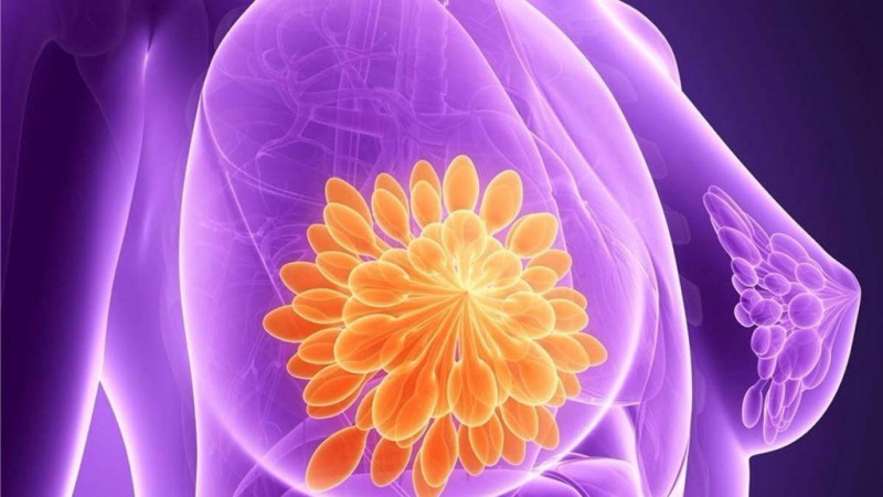 乳腺增生是乳腺癌的前兆?千万别自己吓自己